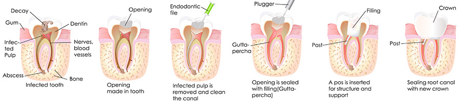 West Los Angeles family dentist | root canals| Le Chic Dentist