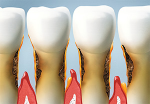 West Los Angeles family  dentist | gum disease treatment, bleeding gums| Le Chic Dentist