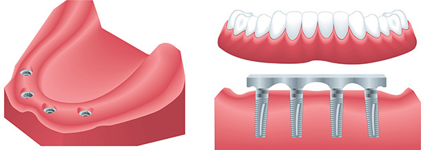 West Los Angeles cosmetic dentist | dental implants, denture implant| Le Chic Dentist
